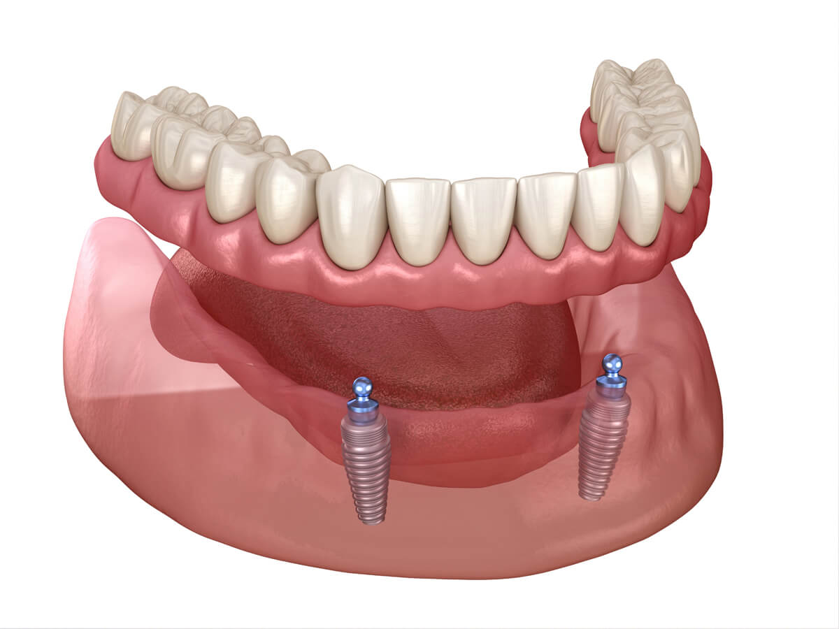 Protezy overdenture